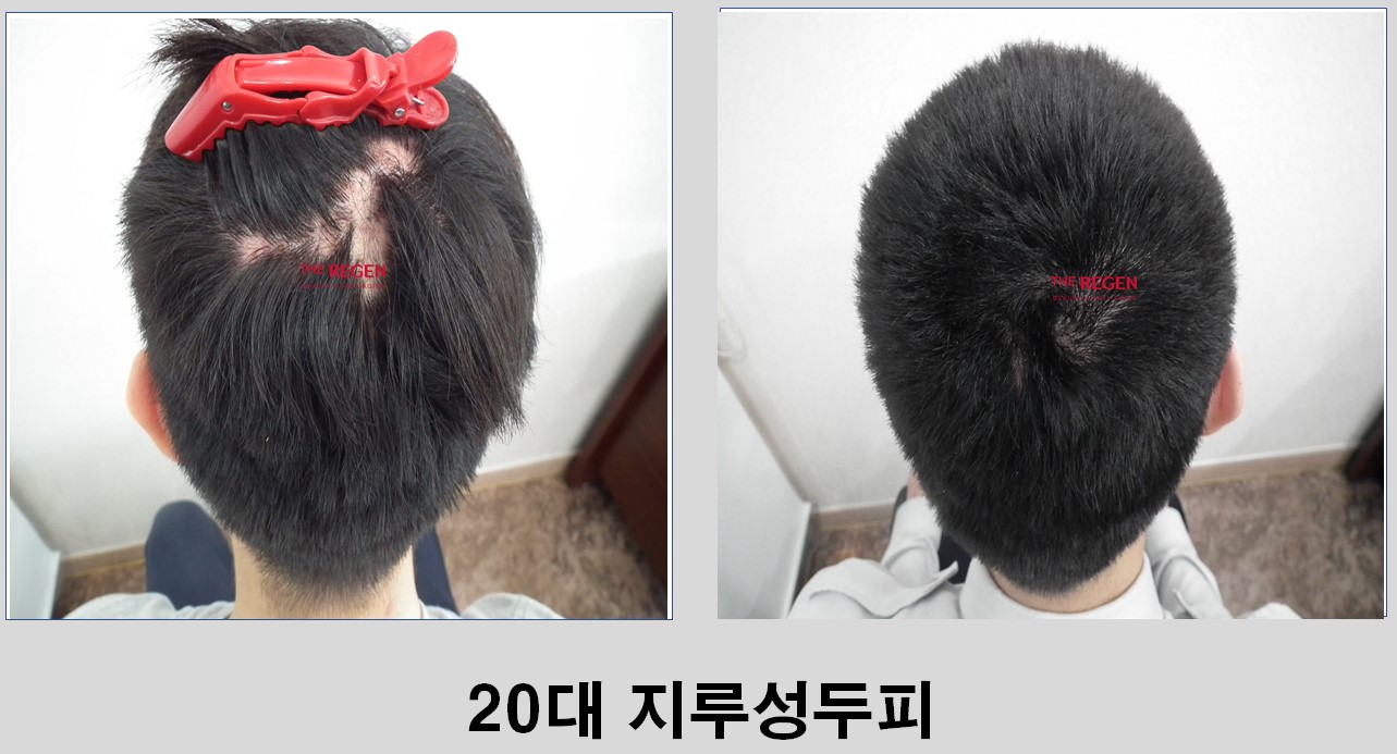 20대 지루성두피 before after